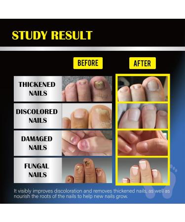 Effective Toenail Fungus Treatment - Repair & Renew Damaged Nails | 30ML Nail Fungus Solution - Buy Online on GoSupps.com