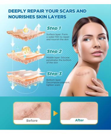 2X Potency Scar Cream - Rapid Deep Repair for C-Section Acne Keloid Burn & Stretch Marks | Silicone Gel Scar Treatment | 1.76oz - Fast International Shipping - Buy Online on GoSupps.com