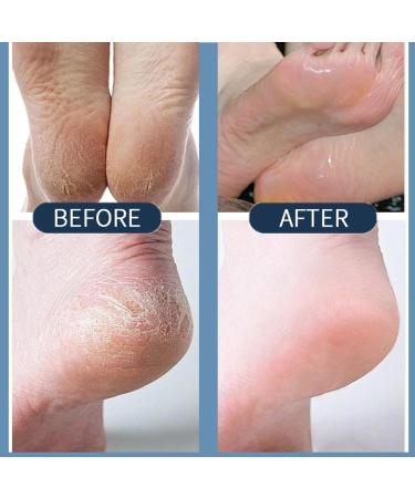  JIAOY Urea cream 60% 60% urea cream for cracked heels and dry skin repairing cream for cracked heels - Moisturizing cream for hands and feet - Skin softening cream - Buy Online on GoSupps.com