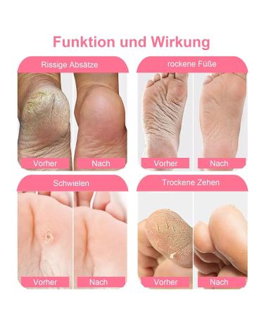 Buy SDSM Foot Mask for Hard Skin - 2 Pairs of Peeling Socks for Dead Skin & Cracked Heels - Plant-Based Moisturizing Formula for Baby Soft Feet (Rose) - International Shipping Available - Buy Online on GoSupps.com