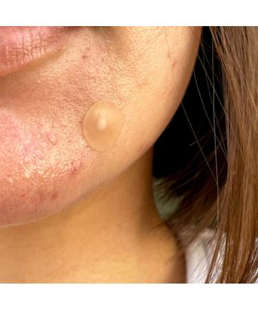 PEACE OUT Jumbo Acne Healing Dots - Fast-Acting Anti-Acne Patches with Salicylic Acid (40 Dots) - Buy Online on GoSupps.com