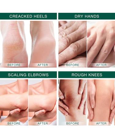 Urea 40% Foot Cream For Cracked Heels And Dry Skin Urea Cream for Feet with Hyaluronic Acid Maximum Strength for Hand Foot and Body Care Natural Moisturizes Nourishes Softens Dry Rough Skin - Buy Online on GoSupps.com
