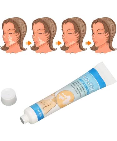Dauerhaft Vitiligo Treatment Ointment - Herbal Extract Vitiligo Cream for Skin Pigmentation - 0.7oz - Buy Online on GoSupps.com