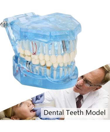 Adult Dental Implant Tooth Model - Blue-Transparent Acrylic for Pedagogical Demonstration | Removable Simulation for Dentists - Buy Online on GoSupps.com