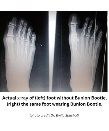 Bunion Bootie Ultra-Thin Bunion Corrector for Women - Big Toe Straightener for Bunion Relief | Premium Bunion Socks for Bunions Correction - Medium-Left Foot - Buy Online on GoSupps.com