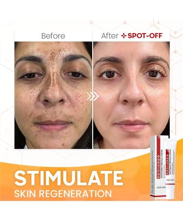 Spot Off Freckle Whitening & Dark Spot Corrector Cream - Acne Scar & Melasma Removal Treatment for Face (2 Pcs) - Buy Online on GoSupps.com