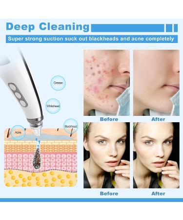 EUASOO USB Rechargeable Blackhead Remover Kit for Women & Men - Electric Pore Vacuum Tool with 10 Filters & 5 Rubber Rings - Buy Online on GoSupps.com