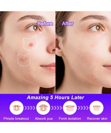 Buy Cute Cat Pimple Patches | 120 Hydrocolloid Acne Dots with Salicylic Acid & Tea Tree - 20 Colors Available | Fast International Shipping - Buy Online on GoSupps.com