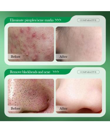 Acne Cream 50g Acne Treatment Gel 3% BHA Spot Cream for Acne Acne Spot Treatment Acne Moisturiser Face Dark Spot Remover for Face Spot Cream for Teenagers Acne Moisturiser Face acne face cream - Buy Online on GoSupps.com