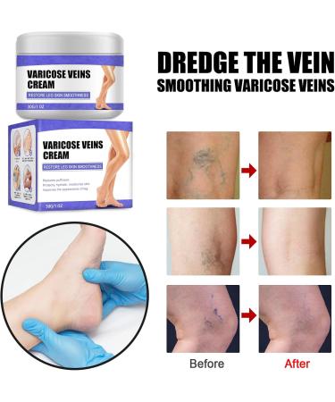 Cream against spider veins for effective treatment of varicose veins Treatment Legs Cream soothes and moisturizes quickly - Buy Online on GoSupps.com