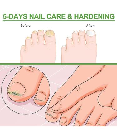 Repairing Treatment for Damaged Nails 10ml Roll-On Stick for Weakened Toenails - Nourishing Hardener for Fingernails and Toenails - Home or Salon Use - Buy Online on GoSupps.com
