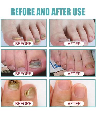3pcs Onyxoguard Nail Growth And Repair Serum Nail Growth And Strengthening Oil - Buy Online on GoSupps.com