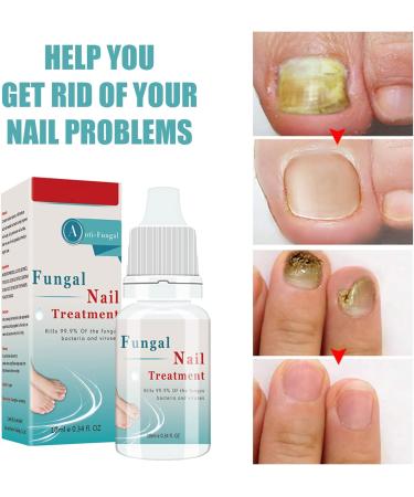Fungal Nail Treatment Solution for Toenails & Fingernails - Repair and Strengthen Nails - Anti-fungal Nail Care - Buy Online on GoSupps.com