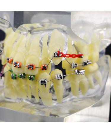 Orthodontic Tooth Model Orthodontic Dental Treatment Malocclusion Model with Brackets Chain Wire - Buy Online on GoSupps.com