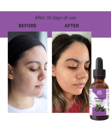 Relaxcation Elderberry Seed Oil Cold Pressed Unrefined Carrier Oil for Face Hair Nails & Body | Lightweight Botanical Extract for Travel Glow Blends & Skin Care (4 oz) 4 Fl Oz (Pack of 1) - Buy Online on GoSupps.com