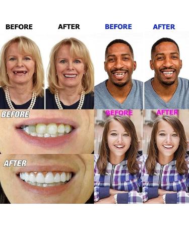 MXRFACTORY DENTATION: Reusable Temporary Veneers for Missing Teeth - 7 Pairs of Jagged Smile Prosthesis for Men & Women - Buy Online on GoSupps.com