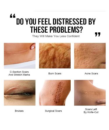 Scar Away Cream: Acne & Stretch Mark Treatment for Old & New Scars - Rapid Repair Formula for Surgical Scars - Shop Now! - Buy Online on GoSupps.com