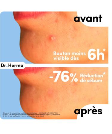 Dr. Herma - Invisible Anti-Pimple Patch - Discreet Fast & Effective Acne Treatment for 6 to 8 hours - Medical Formula Salicylic Acid Hydrocolloids & Tea Tree Oil - Pack of 24 - Buy Online on GoSupps.com