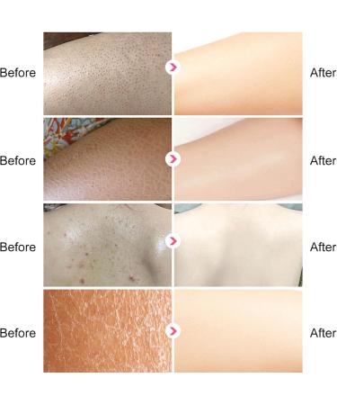 Skin Exfoliating Repair Cream Chicken Skin Care Cream Strawberry Legs Treatment Body Cream Hydrating Moisturising Refreshing Skin Fragrance Repair Body Lotion 50g - Buy Online on GoSupps.com