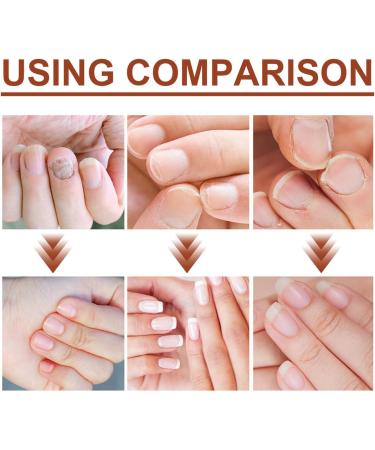7 Days Nail Growth and Strengthening Serum Nail Serum for Strength and Growth Nail Repair Essence Serum Toenail Growth Treatment Restores The Healthy Natural Appearance of Nails - Buy Online on GoSupps.com