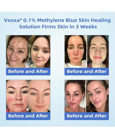 TLOPA 0.1% Methylene Blue Skin Healing Solution Methylene Blue Drops for Healthy Skin Anti-Aging Fullbody Moisturize (1) - Buy Online on GoSupps.com