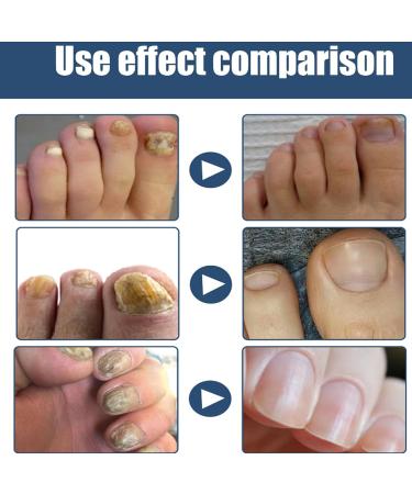 Furzero Nail Fungus & Athletes Foot Treatment Spray - 5PCS - Relieves Foot Odor - Buy Online on GoSupps.com