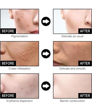  Hengxuan Sunnylas Niacinamide Freckle Removal Serum Niacinamide Serum for Face and Body Spot Removal Essence Moisturizing Essence for Face (2 Pcs) - Buy Online on GoSupps.com
