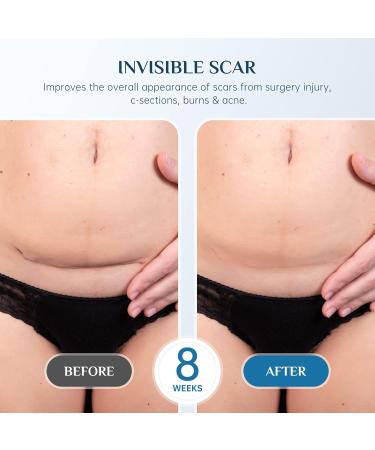 Mebak Silicone Scar Gel - Scar Therapy for Old and New Scars - 30g - Buy Online on GoSupps.com