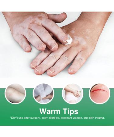 Natural Vitiligo Treatment Cream - Improve Skin Pigmentation & Reduce White Spots | Works on All Skin Types - Buy Online on GoSupps.com
