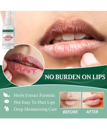 Mouth Ulcer Treatment Spray 30ml Mouth Ulcer Spray OralCare Propolis Ulcer Relief Spray for Wound Protection & Relief Canker Sore Treatment Herbal Mouth Spray Breath Spray for Bad Breath (2Pcs) - Buy Online on GoSupps.com