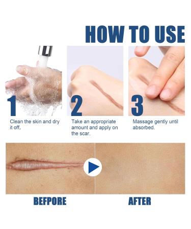 Best Scar Cream for All Types | Scar Angel - Effective Silicone Ointment for Stretch Marks & Post-Op Care - Buy Online on GoSupps.com