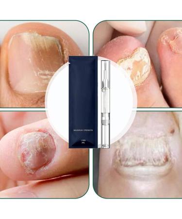 Stylo de r paration pour ongles d'orteils Solution authentique de 3 ml stylo ongles avec ongles entretien quotidien pour homme et femme apr s manucure utilisation en salon domicile - Buy Online on GoSupps.com