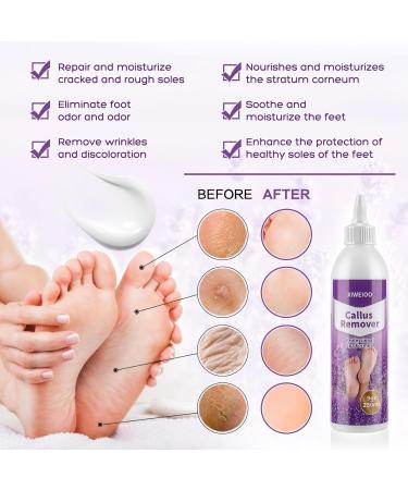 Professional Callus Remover Gel Kit - Exfoliating Cream & Tools for Home Pedicure | Extra Strength Foot Spa Supplies for Cracked & Dry Skin - Buy Online on GoSupps.com