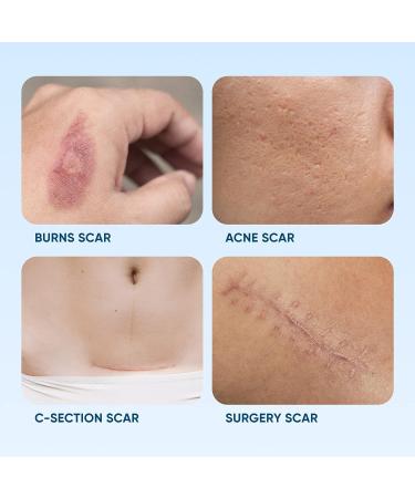 Silicone Scar Removal Sheets - Reusable & Waterproof Patches for C-Section, Burn, Acne, Stretch Marks - 4 Sheets - Buy Online on GoSupps.com