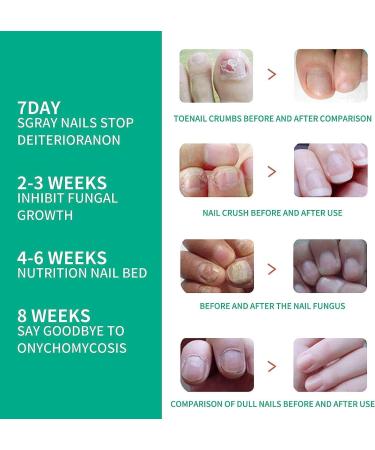 KYOSK Kerassentials Toenail Fungus Treatment Oil Kerassentials for Toenail Fungus Kerasentials Nail Treatment Repair Oil Fix & Renew Damage Nail Broken Cracked & Discolored Nails (6pcs) - Buy Online on GoSupps.com