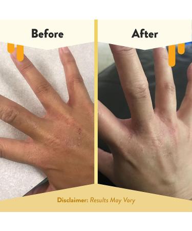 ECZEMA HONEY Premium Witch Hazel & Aloe Spray - Facial Mist and Moisturizer for Dewy Skin (8 Oz) - Buy Online on GoSupps.com