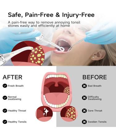 Portable Electric Tonsil Stone Remover & Toothbrush Combo - Effective Suction Tool for Stone Extraction - Buy Online on GoSupps.com