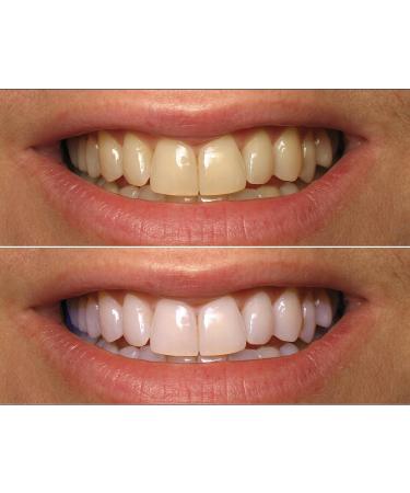 ProDental Teeth Whitening Gel Syringe Refill 10 Pack | 35% Carbamide Peroxide | 60 Treatments | Fast Results | Safe for Sensitive Teeth - Buy Online on GoSupps.com