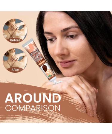  Generisch White Spot Cream - Vitiligo Relief Cream 20g against white spots on skin - Easy to use repigmenting and makeup remover cream - Improves skin pigmentation - Buy Online on GoSupps.com