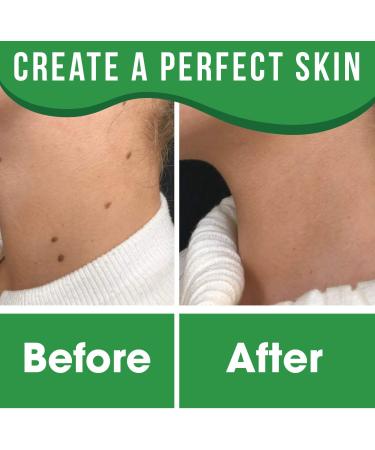 Pimple Patch Device - 72 Herbal Condensed Patches for Small to Large Pimples, Warts, and Blackheads on All Skin Types - Buy Online on GoSupps.com