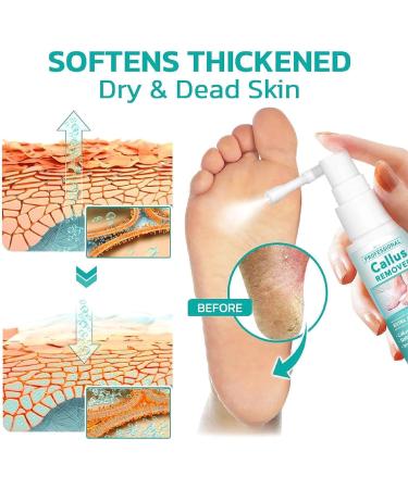 Professional Callus Remover Extra Strength Spray Foot Callus Removal Spray Foot Peeling Spray for Remove Dead Skin and Calluses on Feet (1Pcs) - Buy Online on GoSupps.com