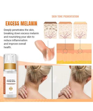 DILUTE Acantho Clear Therapy Spray - Acanthosis Nigricans Treatment for Dark Knuckles & Spots (2 PCS) - Buy Online on GoSupps.com