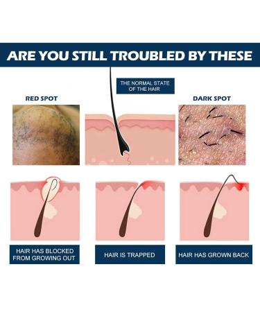 Ingrown Hair Treatment - 30ml Razor Bumps Solution | Mild Moisturizing After Shave Repair Serum for Men - Buy Online on GoSupps.com