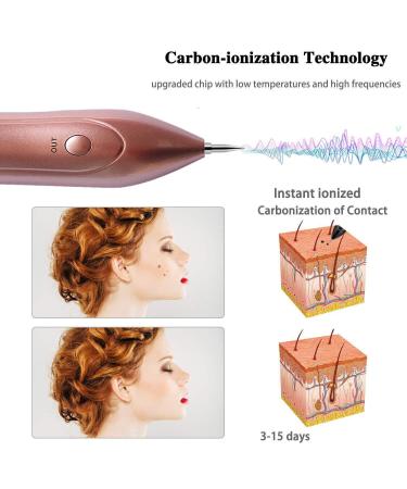 Plasma Pen Device for Removal of Birthmarks Warts & Pigment Spots - 9 Strength LCD Screen Portable Pink - Buy Online on GoSupps.com