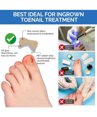 Ingrown Toenail Treatment Kit - 50Pcs No Glue Corrector Patch & Tools - Protect and Repair Ingrown Nails - Buy Online on GoSupps.com