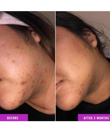  Nuvilo Dark spot corrector serum with roller face and body remover sun and age spot corrector melasma and hyperpigmentation brightening serum with vitamin C and niacinamide (2 pcs) - Buy Online on GoSupps.com