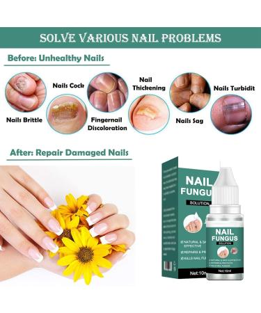 Extra Strong Fungal Nail Treatment for Toenails - Nail Repair Oil for Ingrown Nails - Strengthen and Renew Damaged Nails - 3Pcs Set - Buy Online on GoSupps.com
