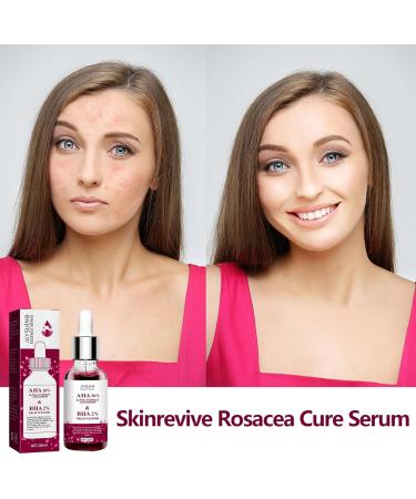 Rosacea Care Rosacea With Natural Moisturizing Fruit Acids Redness Corrector Water Oil Balance Facial Care Improves Skin Relieves Rosacea 30 l - Buy Online on GoSupps.com