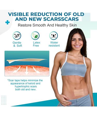Silicone Scar Sheets Tape (1.6 x 60 Roll) - Professional Scar Removal for Surgical Scars, Keloid, C-Section, Burn, Acne - Brown - Buy Online on GoSupps.com