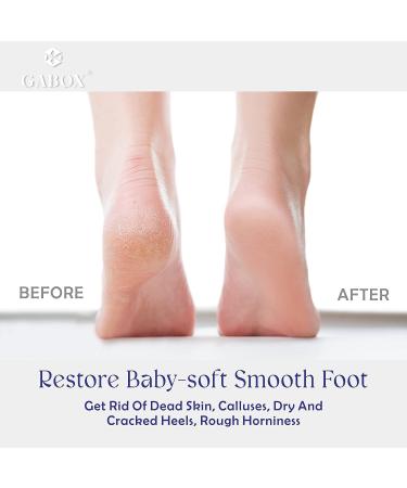 Callus Remover Foot Scrubber | Dead Skin Heel Scraper Pedicure Tool | Purple Foot SPA for Men and Women - Buy Online on GoSupps.com